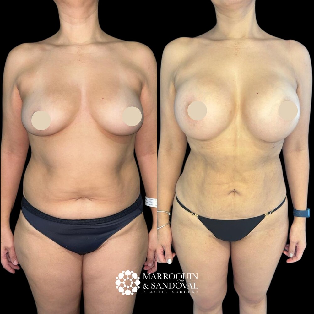 Before and After Result